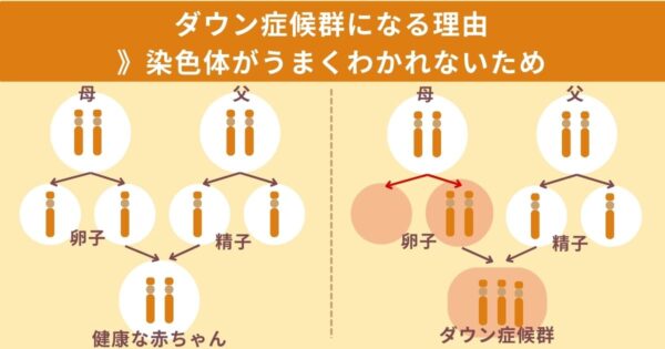 ダウン症候群を生む人の特徴